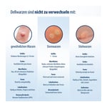 EVOLSIN Dellwarzen Mittel Lösung